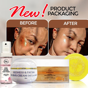Redness & Facial Burn Cream