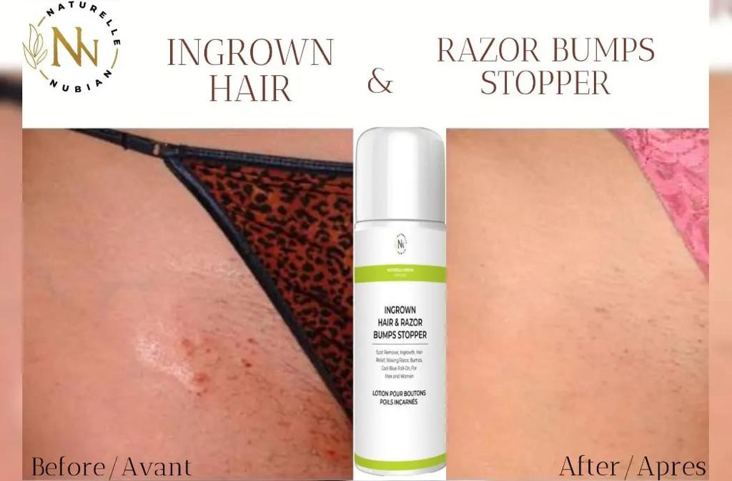 Poils incarnés & Rasoir Bump Stopper ( CONTRE POILS INCARNÉS)