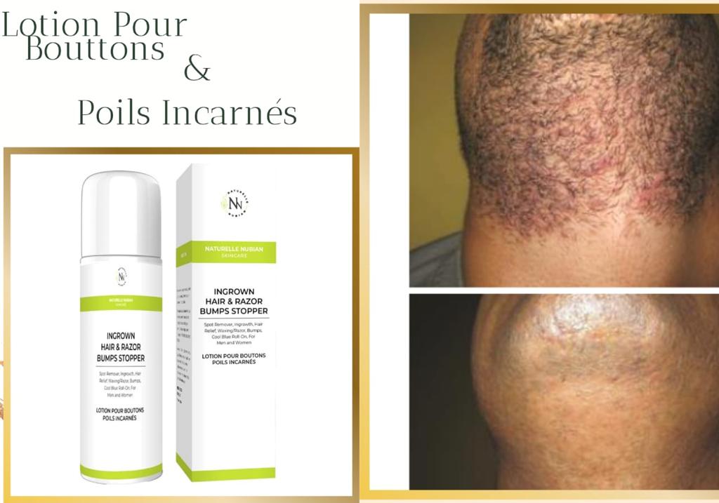 Poils incarnés & Rasoir Bump Stopper ( CONTRE POILS INCARNÉS)