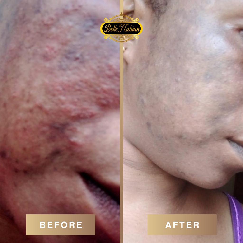 ULTIMATE ANTI-ACNE SET