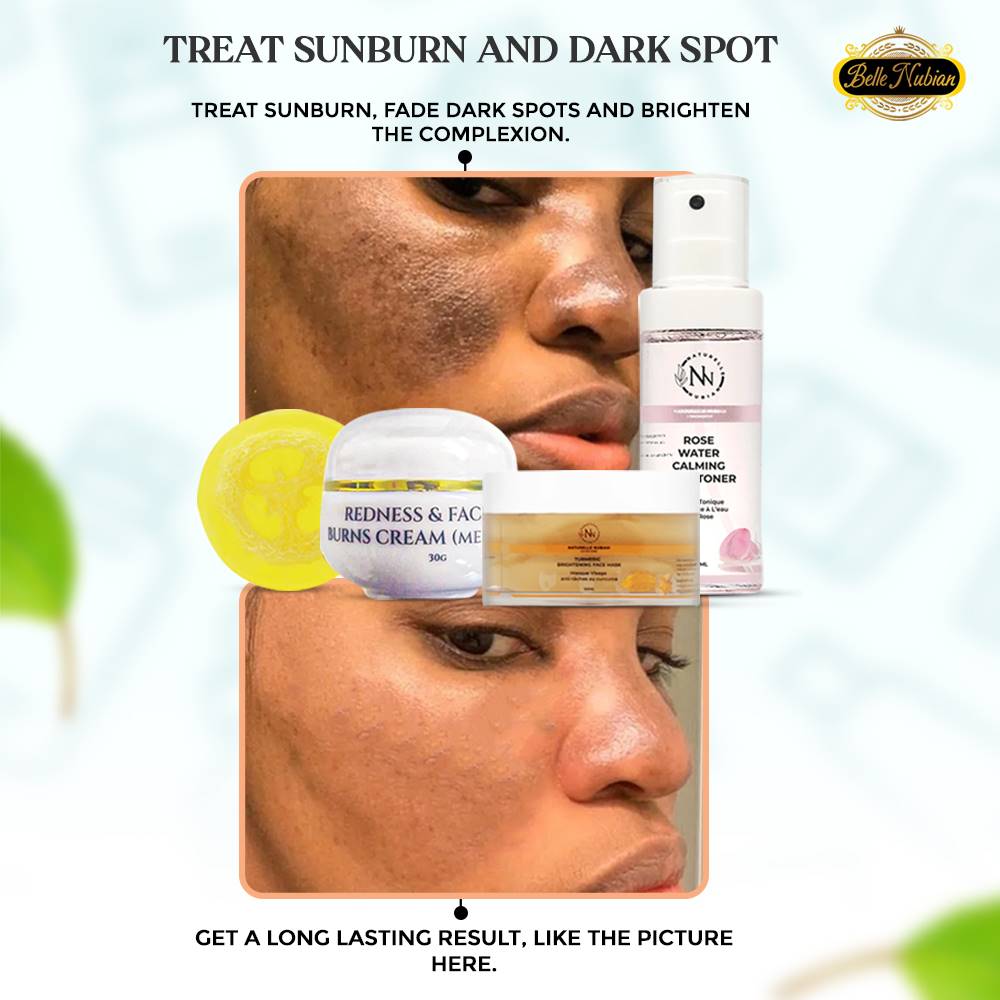 NEW Redness & Burn Set (Perfect for Melasma)